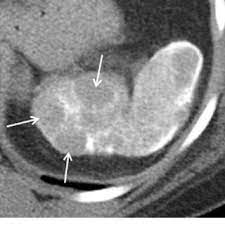 Old Granulomatous Disease Axial Ct Image Shows Multiple Small High Download Scientific Diagram