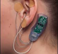 The NSS-2 Bridge: A New Device to Reduce Opiate Withdrawal ...