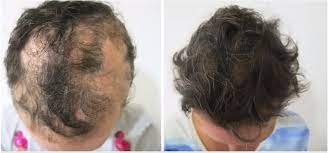 Here's a story about why you should, and why vitamin d can sometimes make the difference between hair loss and hair recovery. Alopecia Areata Testimonials Coimbra Protocol This Is Ms Multiple Sclerosis Knowledge Support Community