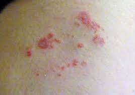 Image result for zoster under breasts