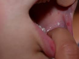 Recurrent Mouth Ulcers And Canker Sores In Children