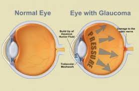 Image result for Intraocular Pressure