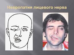 как лечить воспаление тройничного лицевого нерва в домашних условиях Lechenie Nejropatii Licevogo Nerva Prednizolonom Po Sheme Prakard
