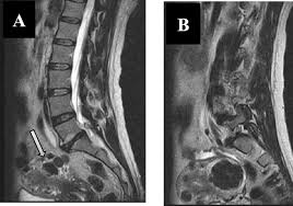 According to research published in the journal bmj, low back strain and pain in the lumbar region is the leading cause of missed days at work and is becoming a global epidemic.many medical professionals point to carrying heavy bags as a common reason for lower back pain at work. Incidental Findings In Lumbar Spine Mri Their Prevalence And Potential Impact On Patient Management Egyptian Journal Of Radiology And Nuclear Medicine Full Text