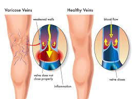 Prevent Varicose Veins | Barr Aesthetics