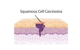 Basal cell, squamous cell, and. Development Of Skin Cancer Oncobeta
