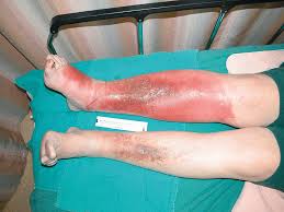 Image result for erysipel photos)