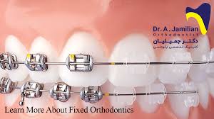 It is the first video of a. Learn More About Fixed Orthodontics Dr Jamilian