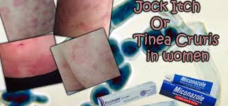 Jock itch, also called tinea cruris, is an infection caused by fungi on your skin. Jock Itch Or Tinea Cruris In Women Causes And Treatment Wivesmag