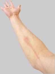 Image result for Nodular Lymphangitis