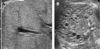 Acute renal failure in children: Figure 1 From Renal Failure In Neonates Infants And Children The Role Of Ultrasound Semantic Scholar