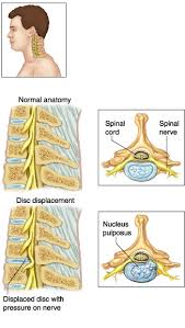 Maybe you would like to learn more about one of these? Displacement Of Cervical Disc Without Myelopathy Office Instructions Timothy Shane Shaw Md Pa