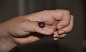 Image result for Pyogenic Granuloma