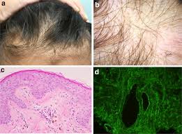 Scalp biopsy results from derm. Hair And Scalp Changes In Cutaneous And Systemic Lupus Erythematosus Springerlink