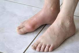 Gout Is A Form Of Arthritis That Often Causes Swelling And Redness In Your Big Toe But Can Also Attack Other Joints Arthritis Foot Remedies Types Of Arthritis