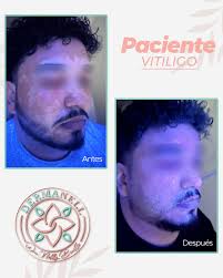 🔶You Láser El mejor láser para cicatrices de acné, Rejuvenecimiento  facial, labios, cuello, cicatrices queloideas o hipertroficas, Vitiligo,  alopecia, poros dilatados, estrías! Pregunta por nuestros paquetes o agenda  una cita con nosotros