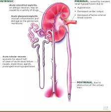 Image result for Postrenal Failure