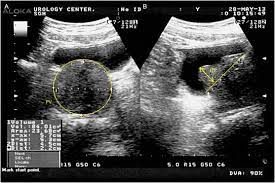 The earlier the detection of prostate cancer, the better the patient's chance of survival is. Pathophysiology Of Clinical Benign Prostatic Hyperplasia Sciencedirect