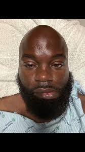 My Life-Changing Stroke Experience and Recovery