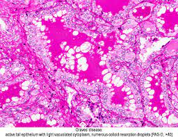 These antibodies activate the receptor, leading to development of a goitre and symptoms of hyperthyroidism, such as heat intolerance. Pathology Outlines Graves Disease