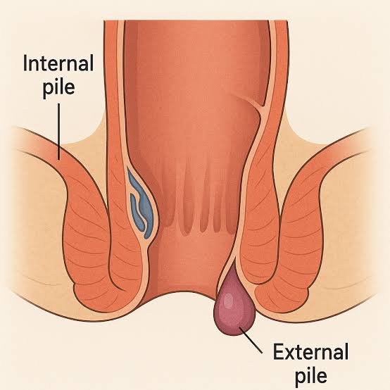 Piles Hemorrhoids Laser Treatment