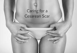 Pin On Cesarean Section