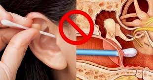 Teknik 'ear weaking' untuk mengeringkan nanah dalam telinga. Rupanya Cara Kita Bersih Telinga Selama Ini Salah Ini Cara Betulnya