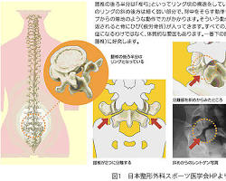 腰椎分離症の画像
