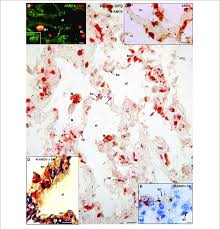 Jun 08, 2021 · most hantavirus infections tend to occur in the spring and summer. Human Lung From Lethal Hantavirus Pulmonary Syndrome Hps Cases A Download Scientific Diagram
