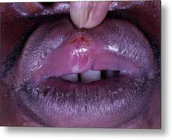 Image result for syphilis ulcer