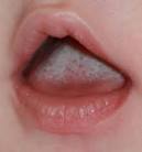 Trske hos barn - Apotek 1