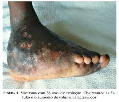 Fungo pode chegar ao cérebro. Scielo Brasil Infeccoes Causadas Por Fungos Demacios E Suas Correlacoes Anatomo Clinicas Infeccoes Causadas Por Fungos Demacios E Suas Correlacoes Anatomo Clinicas
