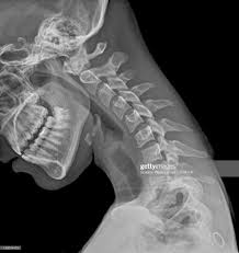 Normal Flexed Neck X Ray Of The Flexed Cervical Spine Of A 20 Year Xray Art Neck Injury Human Body