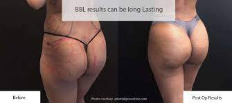 Initially, more than one procedure may be needed to achieve desirable results. Bbl Recovery Brazilian Butt Lift Recovery Guide 2021
