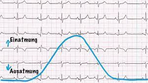 Normaler Puls Sinusrhythmus Smartphone Ekg Routinemessung Cardiopraxis