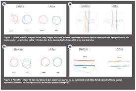 4 Ways To Use Eye Tracking In Your Practice Eye Tracking Vision Therapy Virtual Reality Systems