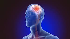 A left hemispheric stroke happens when blood cannot flow to the left hemisphere (side) of your brain. Stroke Dana Foundation