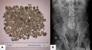 Full Text X Ray Free Ultrasound Guided Percutaneous Nephrolithotomy In Supine Po Rru