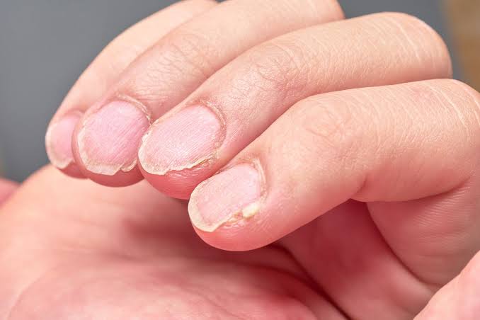 Alopecia Areata Nails: Images, Symptoms, and Treatment