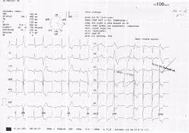 Plicní embolie je po srdečním infarktu a cévní mozkové příhodě třetí nejčastější. Ekg Z Praxe 32 Medicina Nemoci Studium Na 1 Lf Uk