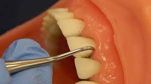 Then work on the teeth surfaces of the tongue side. How To Use Sickle Scalers Youtube