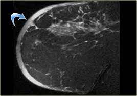 Because inflammatory breast cancer usually develops quickly and spreads aggressively to other parts of the body, women diagnosed with this disease, in general, do. The Radiology Assistant Mri Of The Breast