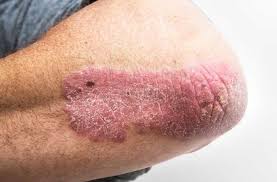 Download discussion guide & info on rx treatment option for adults with active psa. Are You Suffering From More Than Just Psoriatic Arthritis Cleveland Clinic