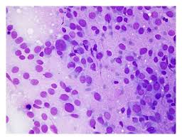 Image result for Chondrosarcoma