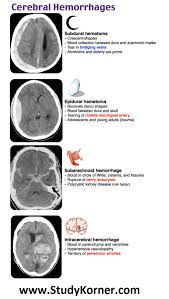 Cerebral Hemorrhages Neurological Assessment Med School An Epidural Hematoma Presents As A Hyperdense Lentic Neurological Assessment Med School Medical Anatomy