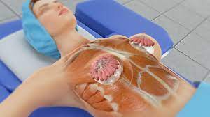 The lower part of the breast becomes more projecting and the breast takes on a more natural, 'teardrop' shape, even if it is a round implant, she says. Breast Augmentation Johns Hopkins Medicine