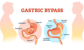 weight gain after gastric byp