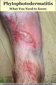 Morning glories are not universally hated. Phytophotodermatitis Plants That Cause It How To Treat It