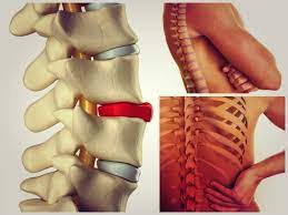 Hernia moderata lombara si cervicala sunt comune si descoperite accidental la pacientii peste 20 de ani. Hernia De Disc Se Poate Opera Si Endoscopic