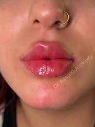 Harmony face technique ❤️‍🔥🥰 اذابة فلر الوجه القديم المحقون بطريقة خاطئة  وحقن الوجه بطريقة الشد والسحب 🥰❤️‍🔥 الدكتورة أصالة العلوي